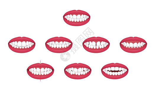 牙齿麻烦咬合型歪牙矢量图 se治疗3d拥挤牙科拔牙口服诊所矫正牙列疾病图片