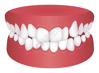 牙齿问题咬合类型矢量图 Crowdin图片