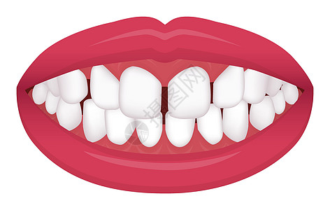 牙齿问题咬合型歪牙矢量图解过度 Spacin图片