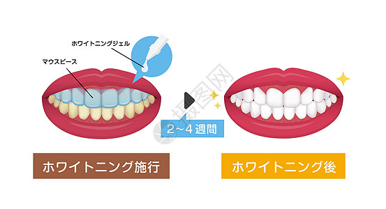 日本前后的牙齿美白矢量图牙科口服药品牙医治疗医生插图健康假牙诊所图片