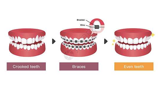 牙齿矫正过程矢量图插图支撑健康医院牙科牙医医生治疗诊所药品图片