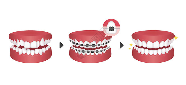 牙套过程矢量图无 tex牙齿牙医矫正健康医院卫生凹痕金属支撑卡通片图片