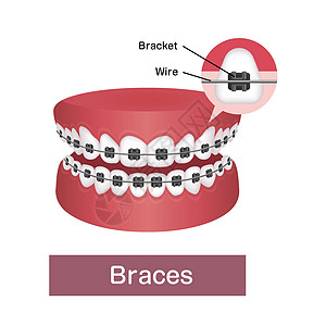 它制作图案的牙套平面矢量医生诊所卫生医院牙齿牙医药品金属口服治疗图片