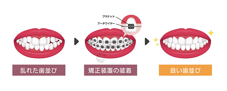 牙齿矫正过程矢量图日本治疗医生医院卫生牙科牙医口服药品健康支撑图片