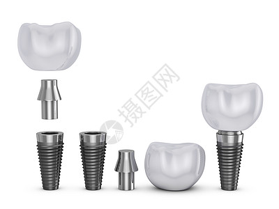 种植牙治疗假肢牙医植入物搪瓷假牙矫正牙齿磨牙手术图片