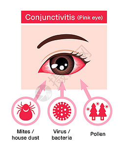 它制作图案的结膜炎粉红色眼病媒的成因医生眼科治疗血丝症状发痒结膜验光发烧眼球图片