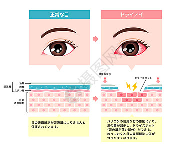 正常眼和干眼的比较图 眼睛表面的横截面 日本人案头药店眼科眼球过敏瞳孔青光眼药品办公室工人图片