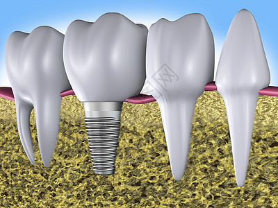 植入和植入牙齿保健药品口腔科植入物健康手术搪瓷假肢矫正磨牙图片