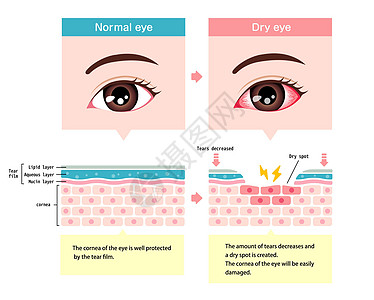 正常眼和干眼的比较图 眼表横截面青光眼疼痛治疗药品眼泪鸢尾花过敏疾病瞳孔工人图片