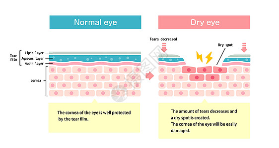 正常眼和干眼的比较图 眼表横截面疾病镜片过敏案头工作瞳孔眼泪工人插图解剖学图片