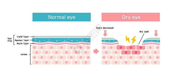 正常眼和干眼的比较图 眼表横截面工人工作眼科办公室眼睛治疗药品案头青光眼过敏图片