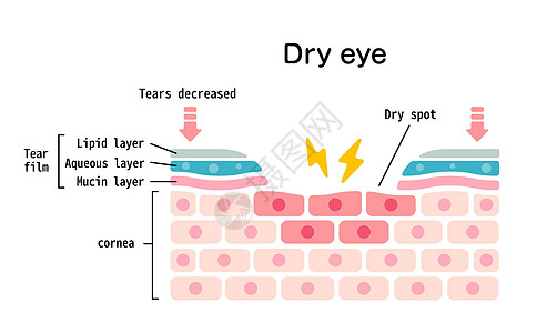 干眼表面的横截面 平面矢量图图片