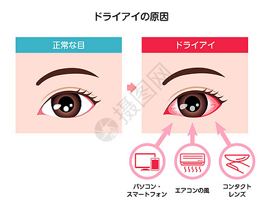 日本干眼症病媒图解的成因眼球工作疼痛眼泪液体眼科镜片治疗案头青光眼图片