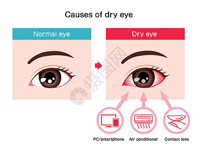 它制作图案干眼症的原因过敏镜片瞳孔工人案头工作解剖学插图液体办公室图片