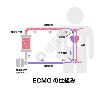 ECMO体外膜氧合结构矢量图日本图片