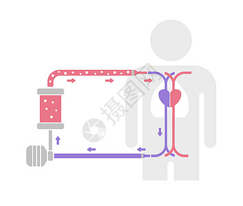 ECMO体外膜氧合结构矢量图无tex图片