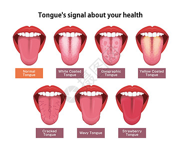 舌头健康标志矢量图 se念珠菌药品癌症口服症状牙齿解剖学插图细菌保健图片