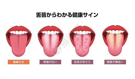 舌头健康标志矢量图白色涂层舌头呼吸念珠菌药品保健治疗器官病人卫生解剖学女士图片