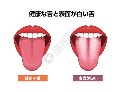 舌头健康标志矢量图白色涂层舌头药品画眉口服疾病器官牙科病人真菌卫生解剖学图片