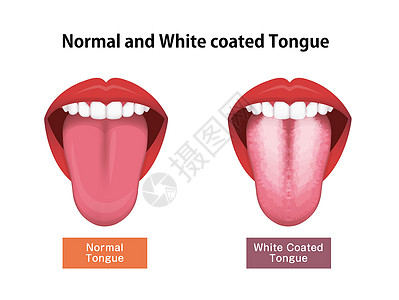 舌头健康标志矢量图白色涂层舌头解剖学治疗疾病画眉药品病人感染牙齿症状卫生图片