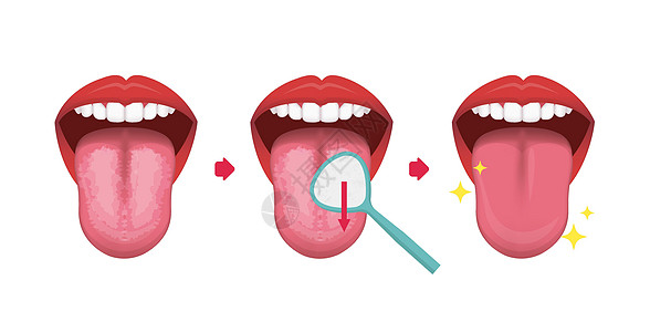 如何清洁你的舌头矢量插图口臭预防女性牙线牙齿清洁工药品牙医口服福利牙科刮刀图片