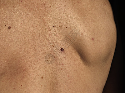 男人背上不断增长的红内奸 皮肤癌症状图片