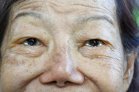 老年妇女的眼水肿症状疾病病人高血压眼皮眼睛过敏药品结膜退休图片
