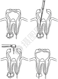 根管手术牙科草图科学钻头程序意义插图衰变运河外科图片