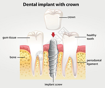 与乌鸦的牙齿植入物牙医绘画牙龈生物牙周神经生理解剖学牙根本质图片