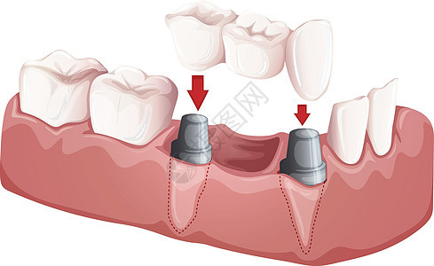 牙桥图片