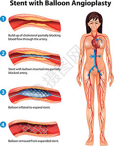 支架血管成形术动脉细胞药品动脉粥样硬化手术医生内皮科学牌匾心脏病图片