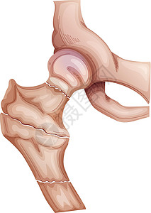 髋部骨折图片