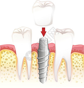 牙冠手术铸件草图程序牙齿科学口服医疗图表金属意义图片
