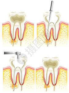 根管治疗图片