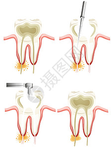 根管手术绘画科学标签差距运河搪瓷牙科脚步牙齿医疗图片