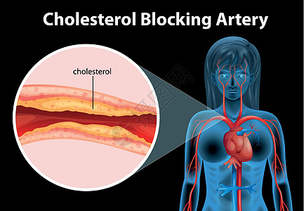 动脉硬化致命疾病细胞插图内皮静脉导管心脏病死亡牌匾图片