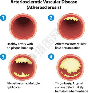 动脉硬化静脉血管动脉艺术插图心脏病硬化积累致命牌匾图片