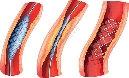 用于打开阻塞动脉的支架图片