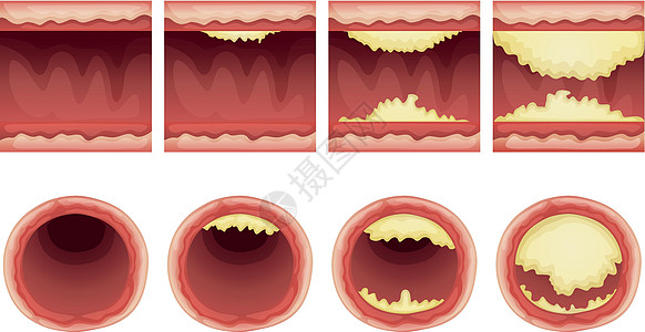 动脉硬化死亡致命静脉动脉粥样硬化心绞痛攻击牌匾导管插图组织图片