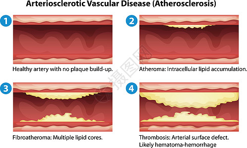 动脉硬化动脉血管支架攻击牌匾组织插图死亡疾病艺术图片