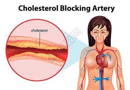 动脉硬化疾病插图细胞致命组织导管牌匾硬化血管死亡图片