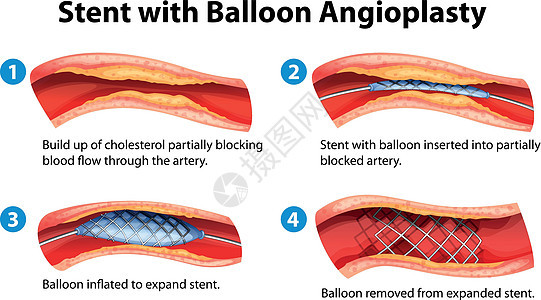 支架血管成形术药品气球积累动脉医生细胞心脏病插图心绞痛艺术图片