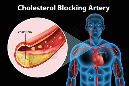动脉硬化致命内皮组织插图动脉粥样硬化心脏病牌匾细胞静脉硬化图片