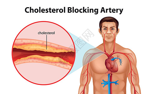 动脉硬化动脉硬化致命静脉攻击艺术死亡支架疾病导管图片