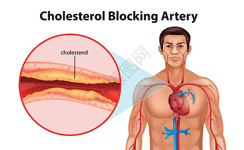 动脉硬化动脉硬化致命静脉攻击艺术死亡支架疾病导管图片