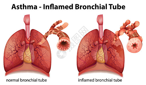 哮喘管道科学绳索胸部插图解剖学生物学组织器官生物图片