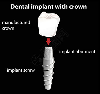 有乌鸦的牙种植体牙齿假牙韧带牙医制品陶瓷假肢程序萎缩牙科图片