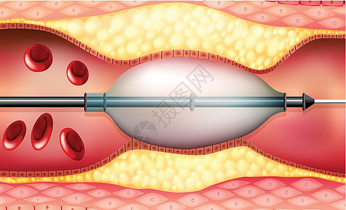 线纹流动支架教育医疗管子通道疾病覆膜绘画科学背景图片
