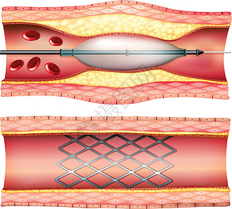 支架血管成形术科学麻醉专家治疗教育心脏病阀门药物局部管子图片