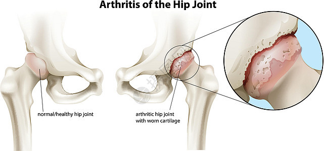 髋关节关节炎炎症压力习惯性磨损滑液表面关节绘画创伤滑膜背景图片